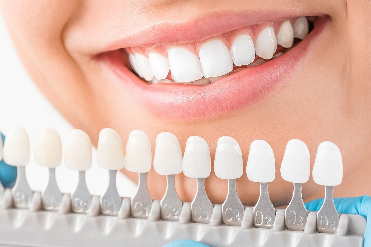 dental implants smile appearance